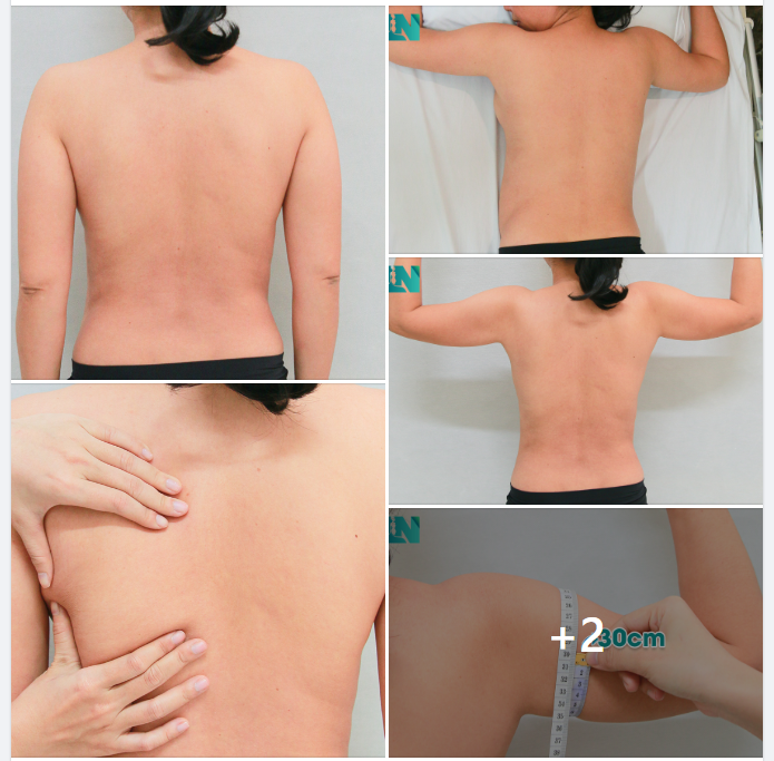 CÂN CHỈNH DÁNG VÓC VỚI VÙNG TAY, LƯNG, NÁCH CHO CHỊ KH U40, TÌM HIỂU RẤT KỸ VỀ ĐỊA CHỈ CHUYÊN SÂU GIẢM MỠ. 