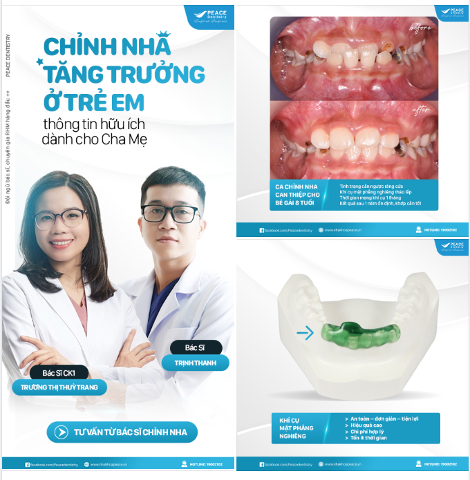CẮN NGƯỢC RĂNG CỬA Ở TRẺ EM VÀ CÁC CÁCH TIẾP CẬN ĐIỀU TRỊ GIAI ĐOẠN SỚM
