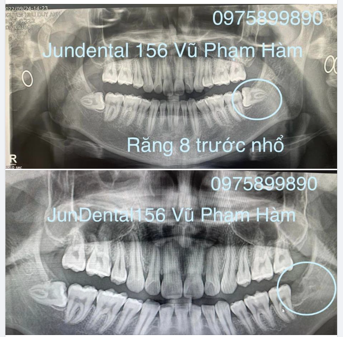 Cập nhật một ca nhổ răng 8 siêu khó được thực hiện bởi bác sĩ của Jun Dental.