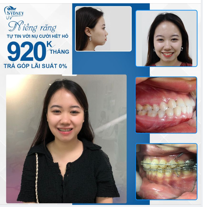 Niềng răng hô hiệu quả chỉ với 920k/tháng