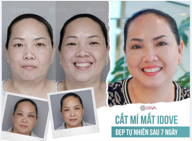 CẮT MÍ MẮT - ĐẸP TỰ NHIÊN SAU 7 NGÀY