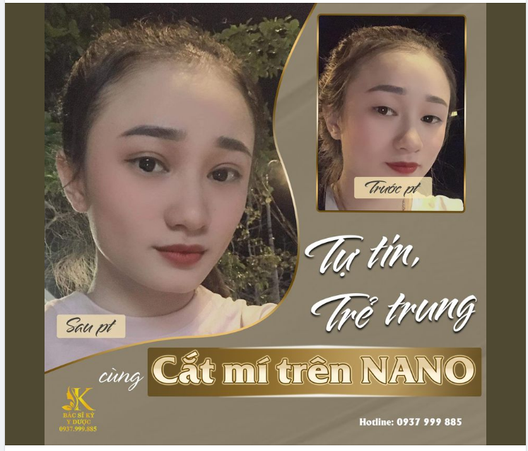 Cắt mí Nano - Công nghệ độc quyền