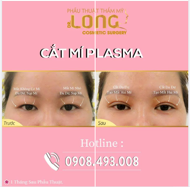 CẮT MÍ NHẸ NHÀNG CÙNG CÔNG NGHỆ PLASMA