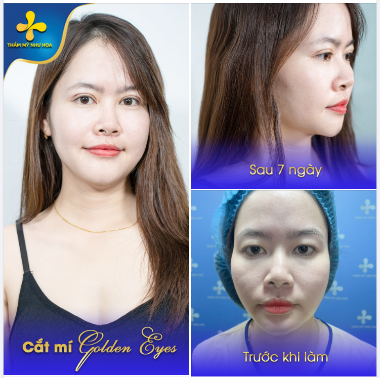CẮT MÍ XONG KHÔNG ĐAU CŨNG CHẲNG BẦM TÍM, TRÒN 1 TUẦN ĐÃ ĐẸP TỰ NHIÊN