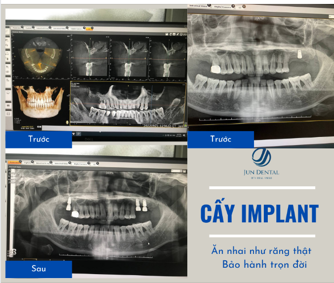CẤY GHÉP 3 RĂNG IMPLANT LẤY LẠI PHONG ĐỘ VÀ KHẢ NĂNG ĂN NHAI HOÀN HẢO CHÚ BIÊN
