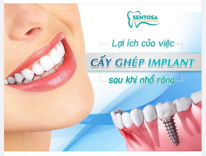 Cấy Implant tức thì sau khi nhổ răng có lợi ích gì