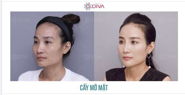 CẤY MỠ COLEMAN, NÂNG MŨI MẶT ĐẸP HÀI HÒA CÂN ĐỐI