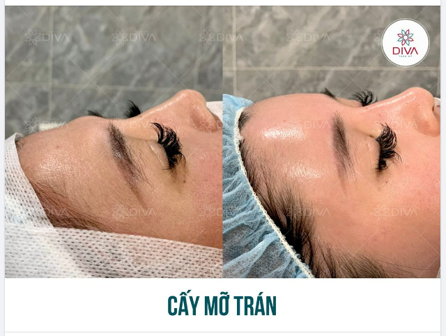 CẤY MỠ COLEMAN TRÁN XONG BAO LÂU SẼ ĐẸP