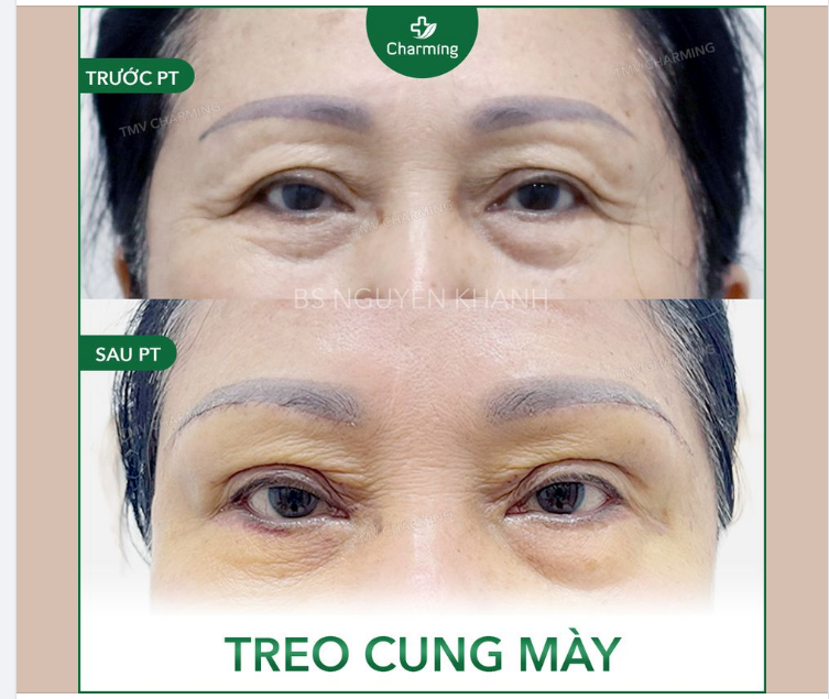 Charming nói nhỏ nè, sau này nếu bạn muốn đi xăm chân mày thì nhớ xem xem cung mày của mình có bị sụp không.