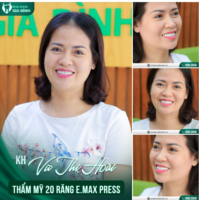 ​​​​​​​Chỉ 2 lần hẹn cùng chuyên gia, sở hữu ngay nụ cười đẹp, đầy cuốn hút mà chị em mong mỏi bấy lâu.