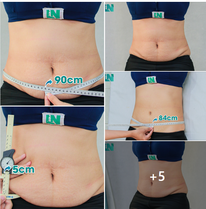 CHỊ KH 42 TUỔI – UỐNG THUỐC GIẢM CÂN NHIỀU NĂM NHƯNG MỠ VẪN HOÀN MỠ, BỤNG DƯỚI CHẢY XỆ.