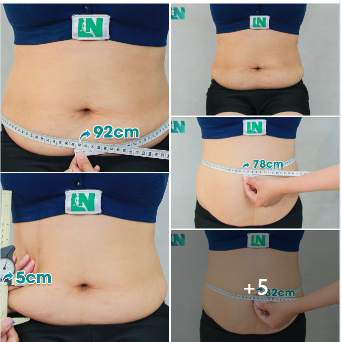 CHỊ KH 45 TUỔI, ĐÃ SINH 3 BÉ – TÌNH TRẠNG BỤNG: NGẤN MỠ DÀY, MỠ CHẢY XỆ.