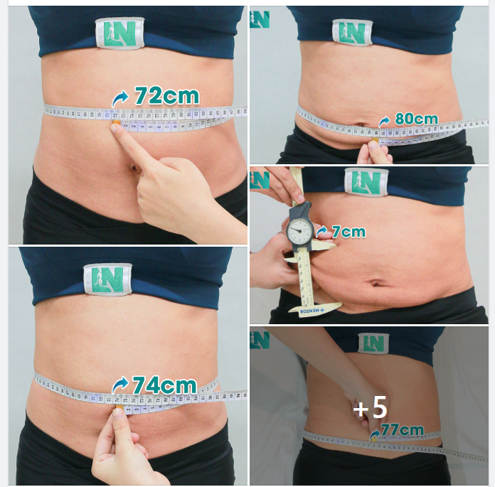 CHỊ KH CÓ NIỀM ƯỚC MONG CHÁY BỎNG - DÁNG ĐẸP EO THON. ĐÃ HÚT MỠ BỤNG (TẠI CƠ SỞ KHÁC) KHÔNG ƯNG Ý