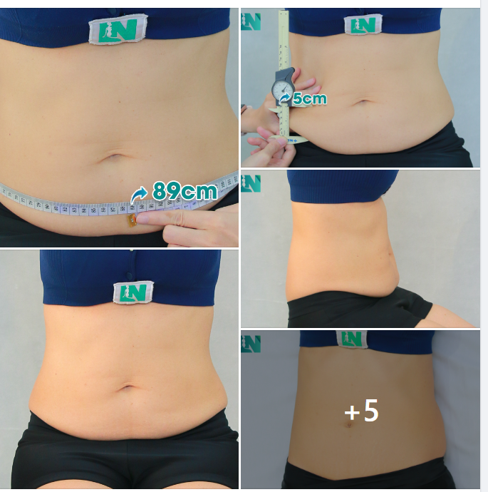 CHỊ KH U50, NGƯỜI THÂN ĐÃ GIẢM MỠ TẠI EKIP BÁC SĨ LƯƠNG NGỌC. 