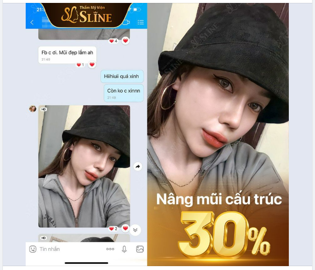 Chị ơi mũi em đẹp lắm ạ! feedback của bạn gái đã nâng mũi cấu trúc tại Thẩm Mỹ Viện Sline 36A Lý Nam Đế