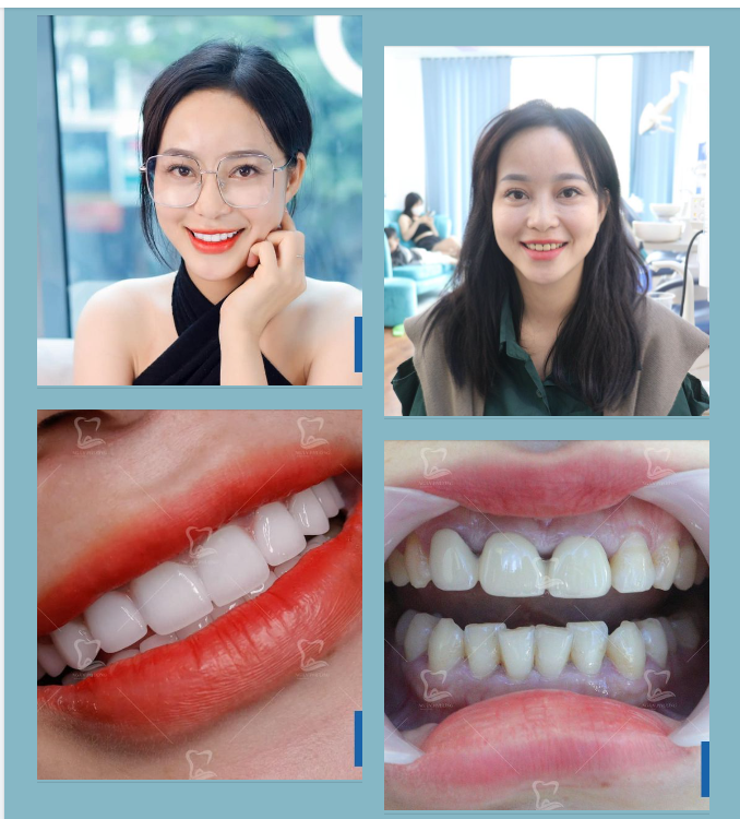 Chị Phạm Liên trước đây đã từng làm cầu răng sứ với những răng trước cửa.