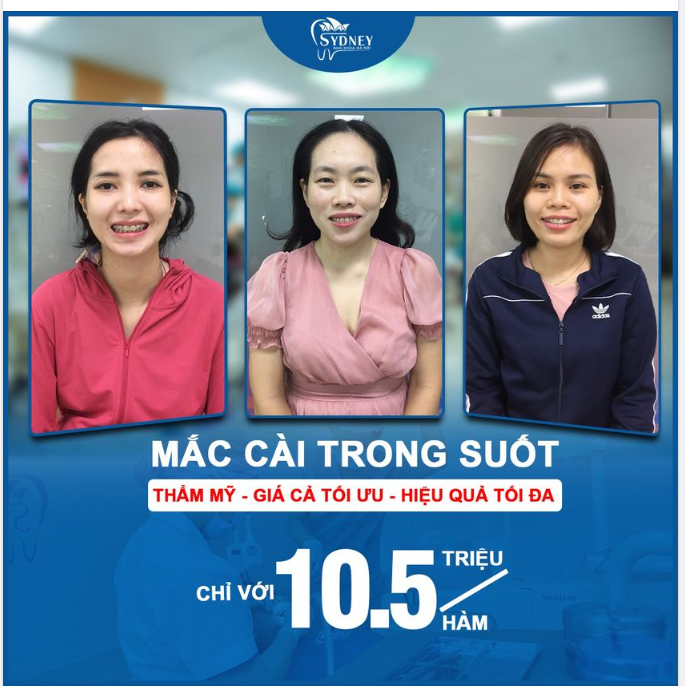 Chi phí có phải nguyên nhân khiến bạn chưa đi niềng răng?