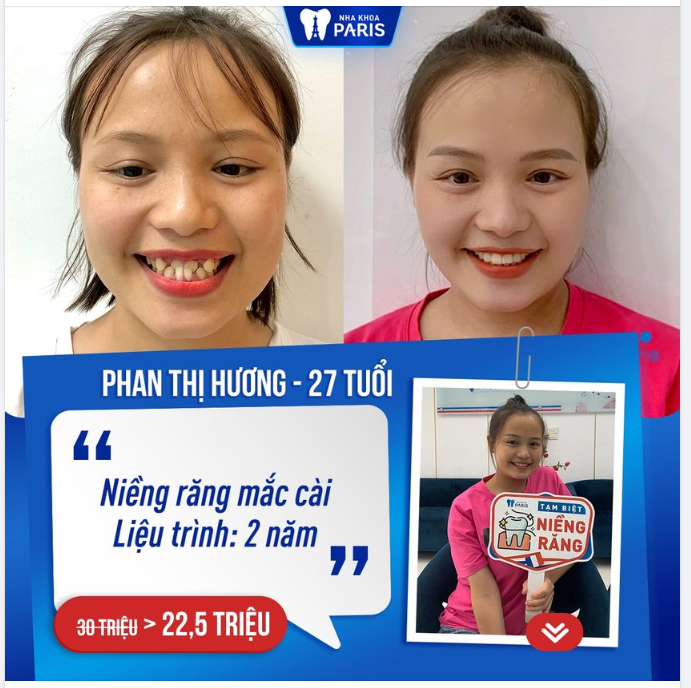 Chỉ sau gần 2 năm chỉnh nha và tinh chỉnh, chị Phan Thị Hương tại Nghệ An