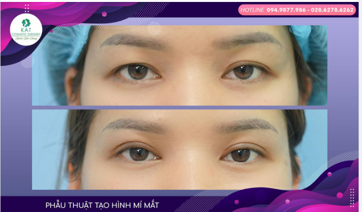 Chỉ với 30 phút phẫu thuật KAT đã giúp bạn tạm biệt đôi mắt không đều, sụp mí và trao lại một đôi mắt hai mí long lanh biết nói.