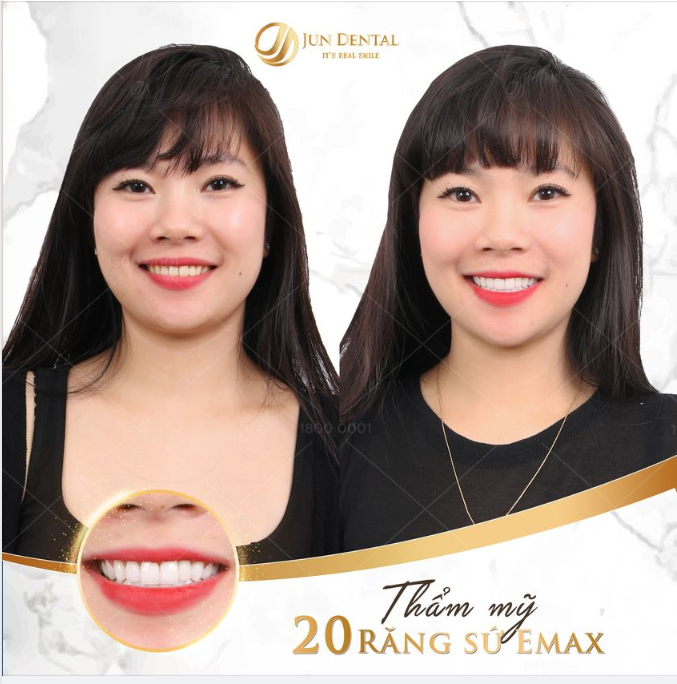 Chìa khóa để sở hữu một nụ cười răng sứ xinh đẹp bền lâu chính 