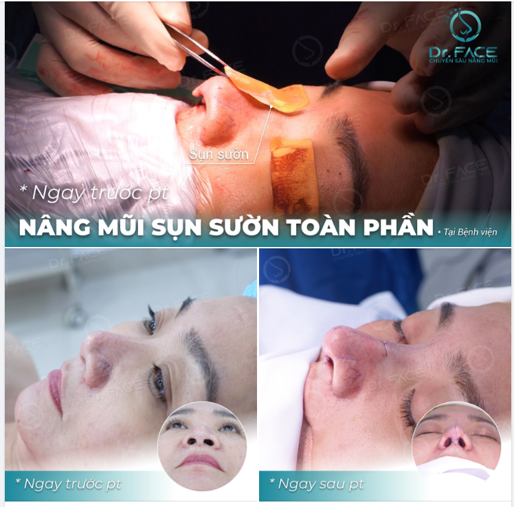 CHIẾC MŨI “CHÁY” QUÁ, PHẢI KHOE VỚI CẢ NHÀ LIỀN NÈ