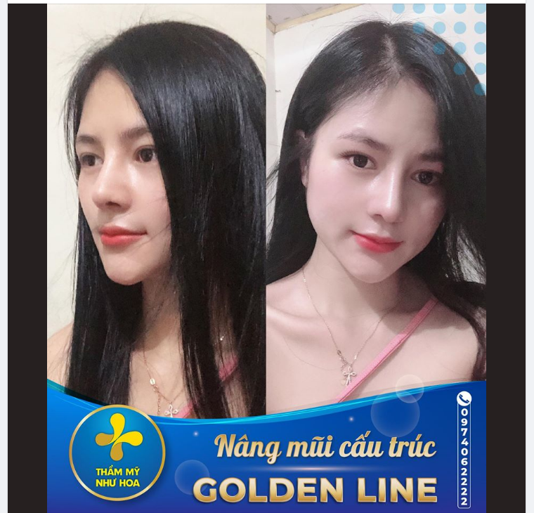 Chiếc mũi đẹp đúng là vị cứu tinh cho toàn khuôn mặt