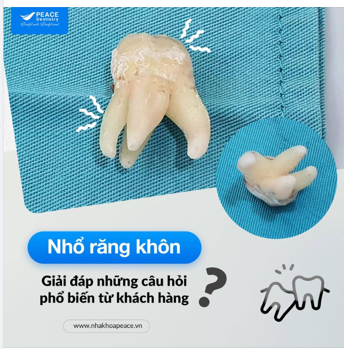 Chiếc răng khôn "hệ xòe" sau khi được tiểu phẫu tại Peace Dentistry