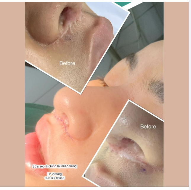 Chỉnh sẹo  sửa lại ca thu ngắn nhân trung cho bạn gái đến từ Q Đống Đa với Dr Vương