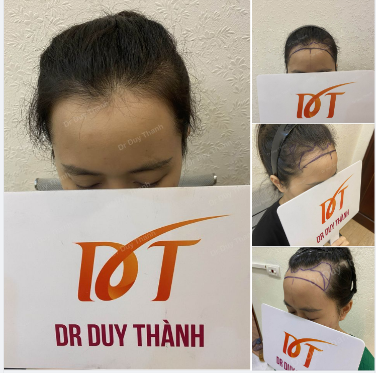 CHUẨN BỊ CẤY 1300 NANG TÓC HẠ THẤP  VẦNG TRÁN CAO CHO KHÁCH NỮ XINH ĐẸP
