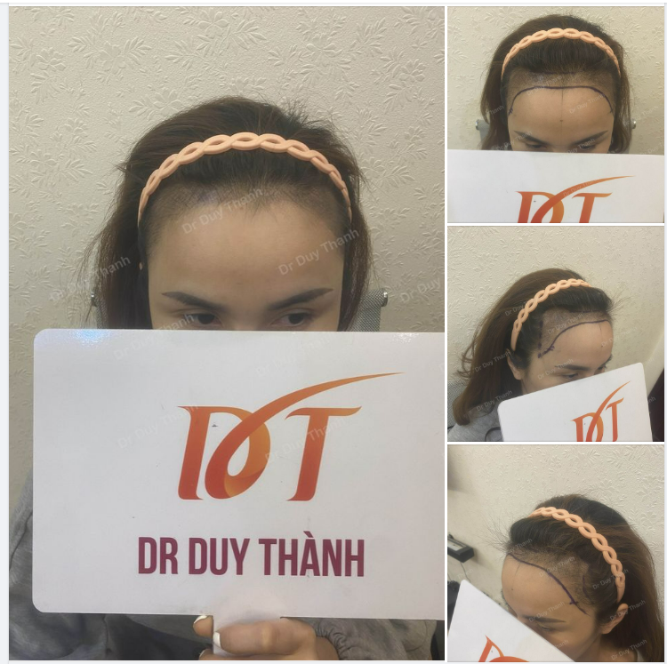 CHUẨN BỊ CẤY 1800 NANG TÓC CHO KHÁCH NỮ XINH ĐẸP TỪ SINGAPORE
