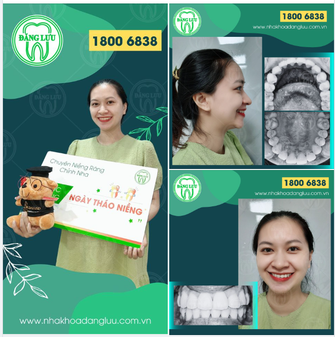Chúc mừng cô gái của nhà Đăng Lưu đã niềng răng thành công