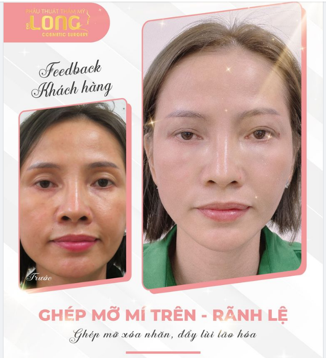 Có bao giờ bạn nghĩ đến ĐÔI MẮT ảnh hưởng rất nhiều đến thẩm mỹ khuôn mặt