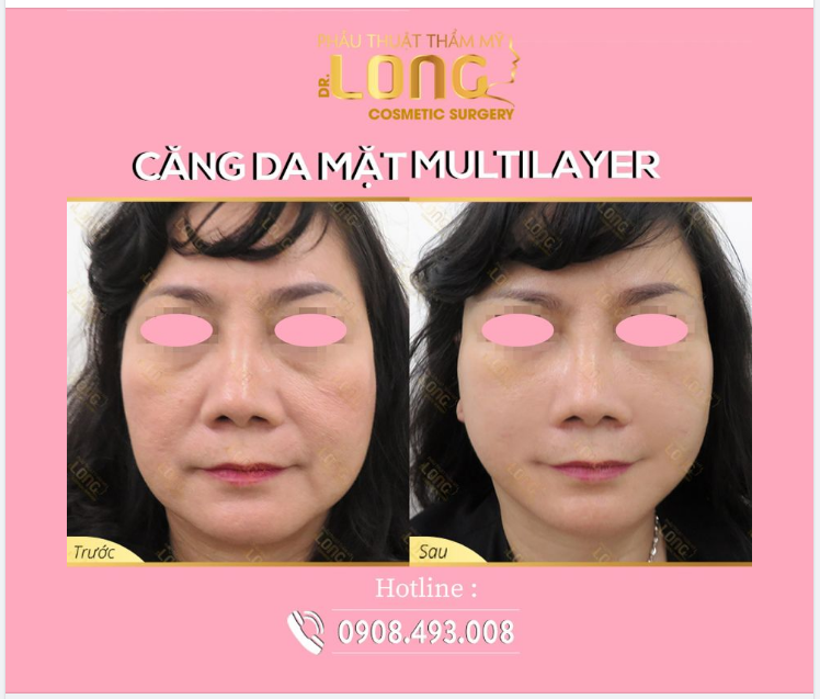 Cô khách “CẢI LÃO HOÀN ĐỒNG” ngay sau 1 lần CĂNG DA MẶT MULTILAYER tại PTTM Bác sĩ Long.