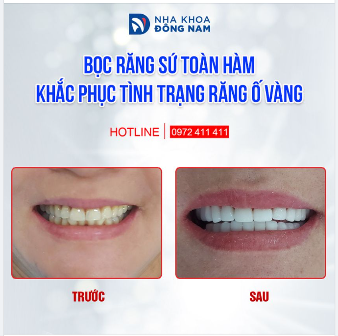 "CÔ MUỐN BỌC SỨ ĐỂ RĂNG TRẮNG HƠN CHỨ KHÔNG MUỐN THAY ĐỔI HÌNH DÁNG RĂNG, GIỮ LẠI DÁNG RĂNG CŨ CHO CÔ NHÉ"