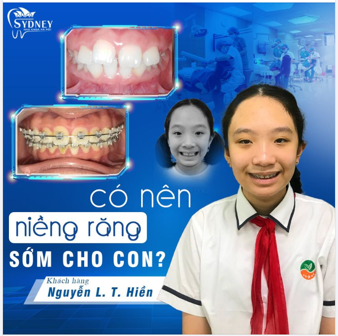 Có nên niềng răng sớm cho con không?