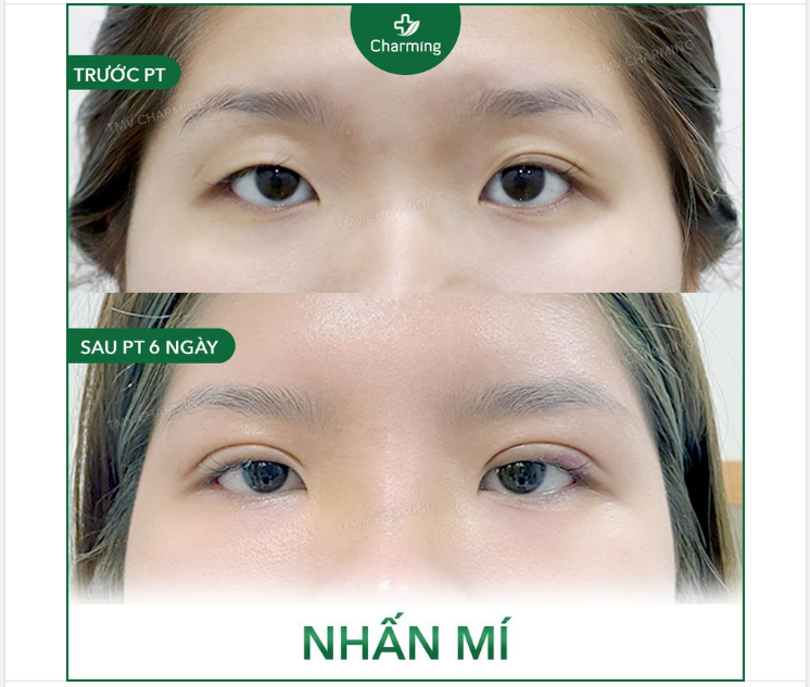 Có những đôi mắt ừ thì cũng là hai mí đó, nhưng nó lạ lắm, một mí đậu, một mí bay đi đâu không ai biết.
