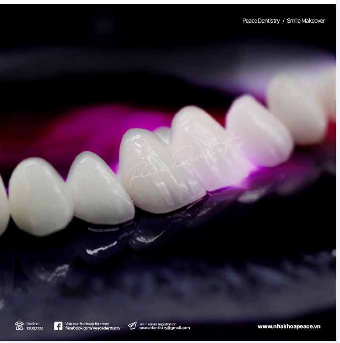 CÓ NHỮNG LOẠI VẬT LIỆU VENEER NÀO? VÀ LOẠI NÀO ĐƯỢC ĐÁNH GIÁ CAO NHẤT?