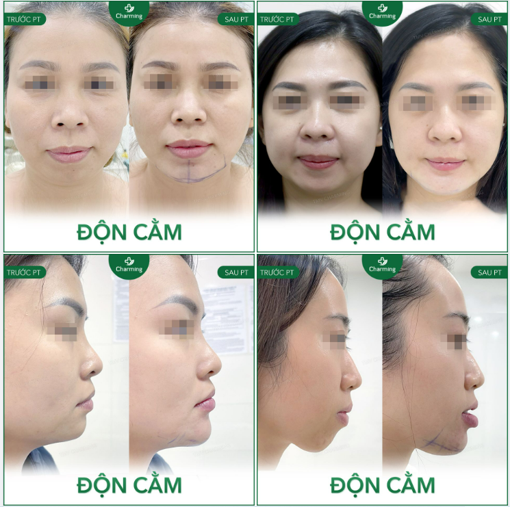 CÓ THỂ BẠN BỎ QUA NHỮNG ĐIỀU PHẪU THUẬT ĐỘN CẰM MANG ĐẾN
