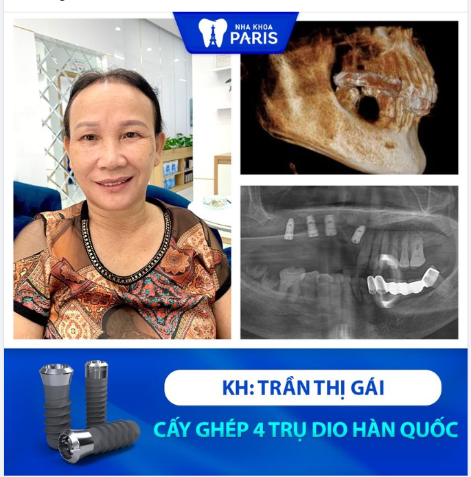 CÔ TRẦN THỊ GÁI LỰA CHỌN GÓI TRỒNG RĂNG DIO HÀN QUỐC TIÊU CHUẨN ĐƯỢC NHẬN NHỮNG GIÁ TRỊ GÌ?