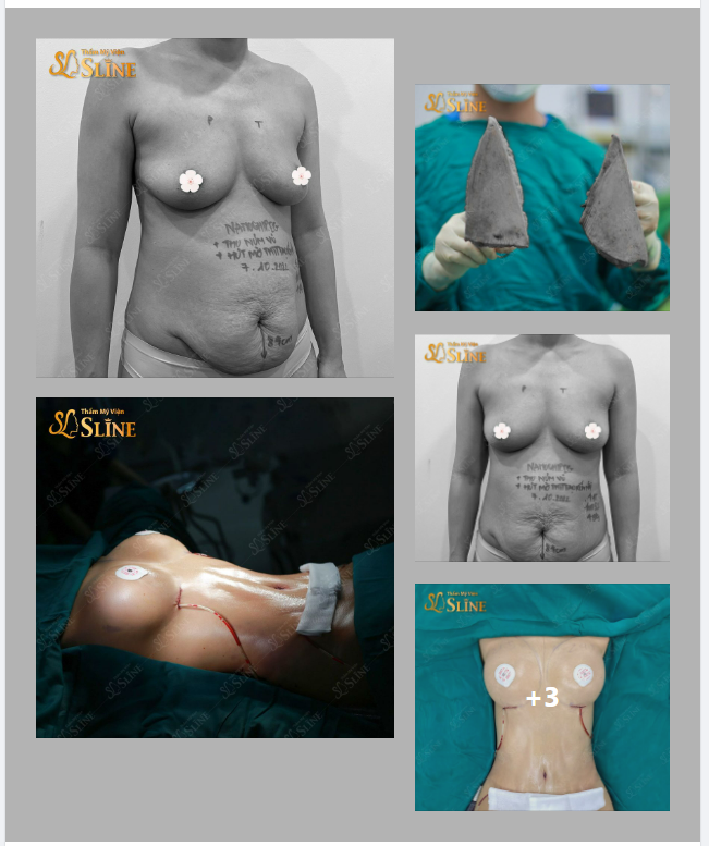 Combo “điêu khắc body” được thực hiện bởi Ekip Sline..
