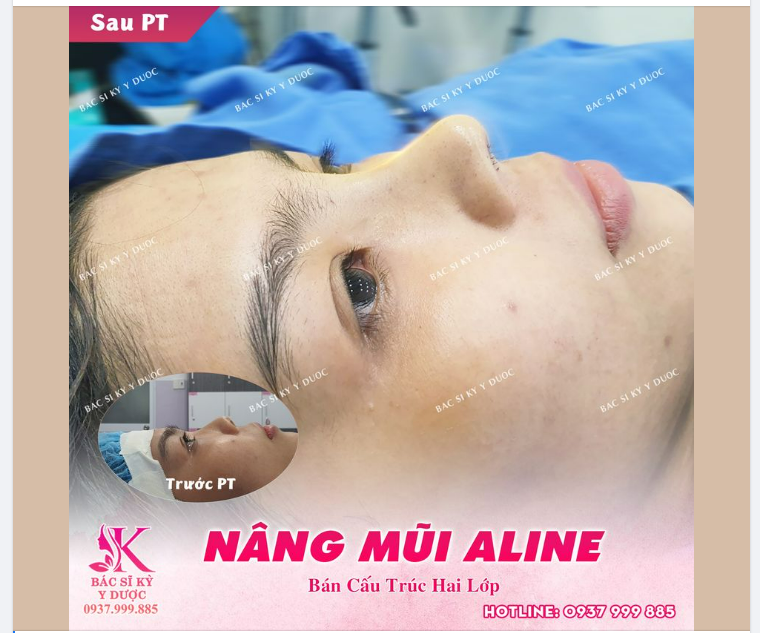 COMBO HOÀN THIỆN DÁNG MŨI ALINE PHONG THUỶ - DÁNG MŨI NHƯ Ý SAU 45 PHÚT
