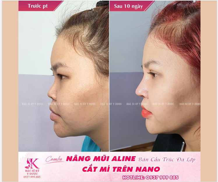 Combo Nâng mũi ALINE bán cấu trúc đa lớp kết hợp Cắt mí trên Nano