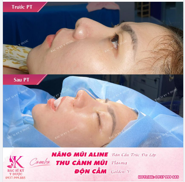 COMBO Nâng mũi - Thu cánh mũi - Độn cằm