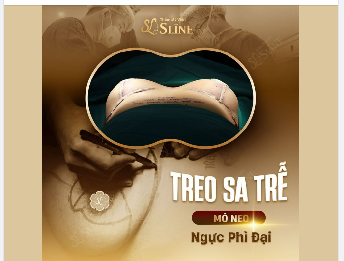 COMBO  Treo sa trễ mỏ neo kết hợp thu nhỏ ngực phì đại được thực hiện bởi ekip Sline.