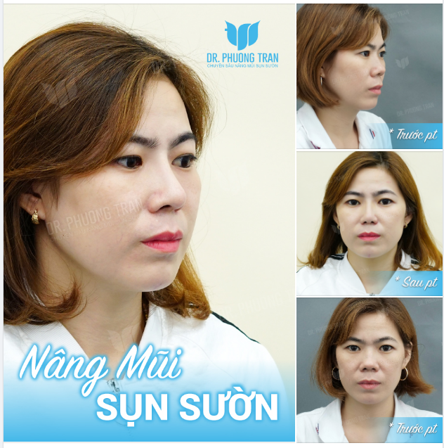 CÒN CHIẾC MŨI BẨM SINH NÀO GỒ GHỀ, LỒI LÕM HƠN MŨI NÀY