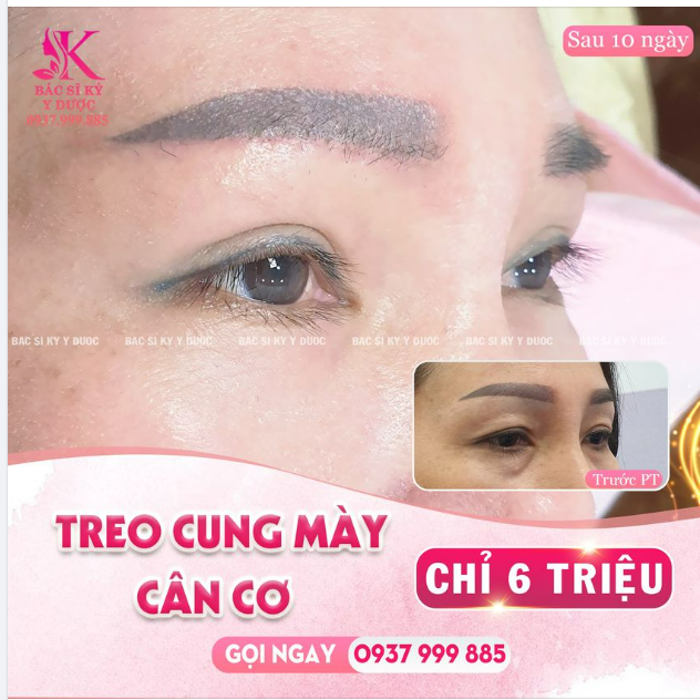 CÔNG NGHỆ TREO CUNG MÀY CÂN CƠ CHỈ 6 TRIỆU