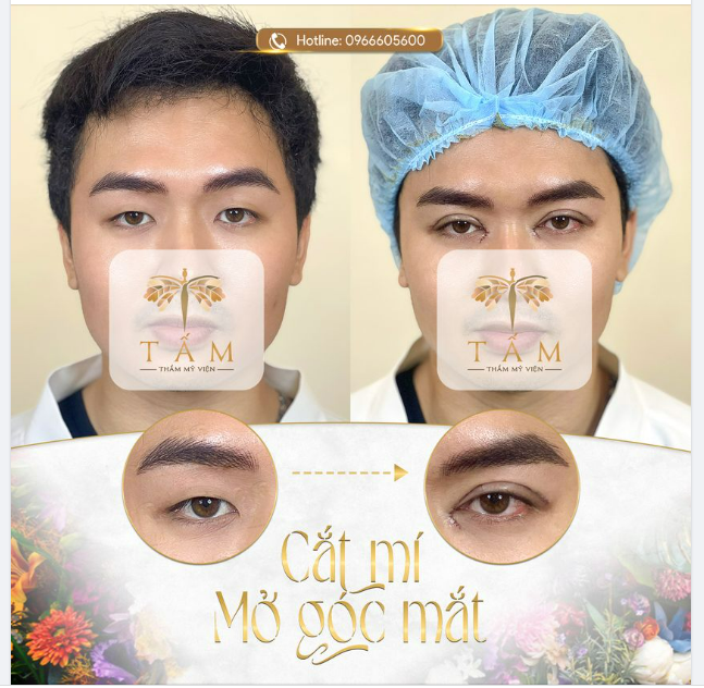 Cùng so sánh hình ảnh trước và ngay sau làm của khách nam nhà Tấm nhé!