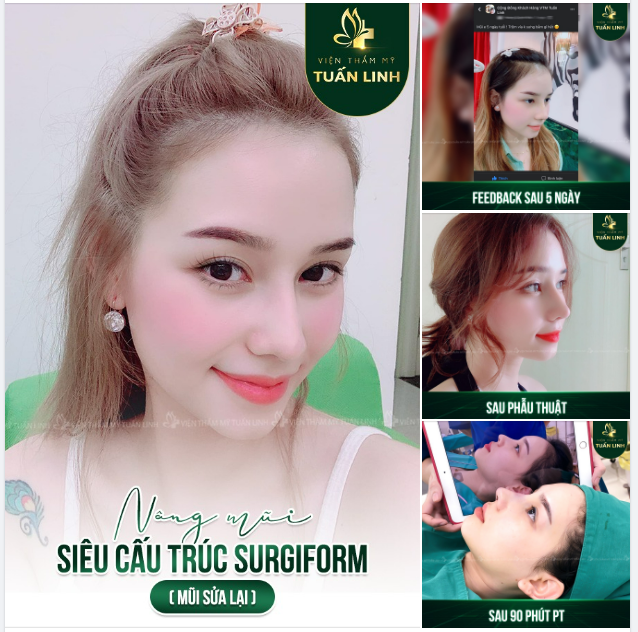  Cùng xem kết quả sửa lại mũi của khách nhà Tuấn Linh sau hơn 1 năm ổn định như thế nào ở ngay pic bên dưới nha!