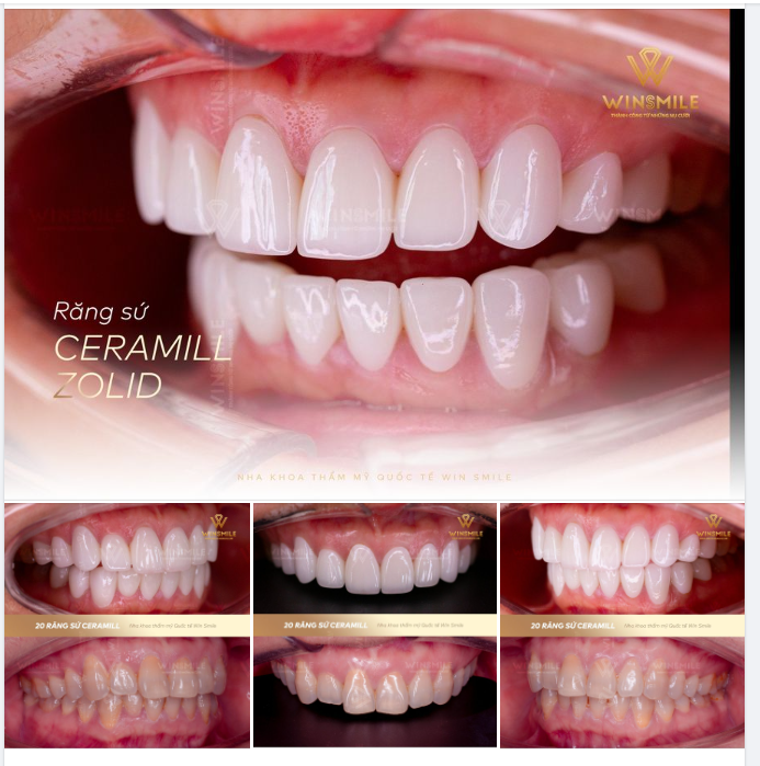 CỨU NGUY CHO RĂNG NHIỄM MÀU KHÁNG SINH NẶNG