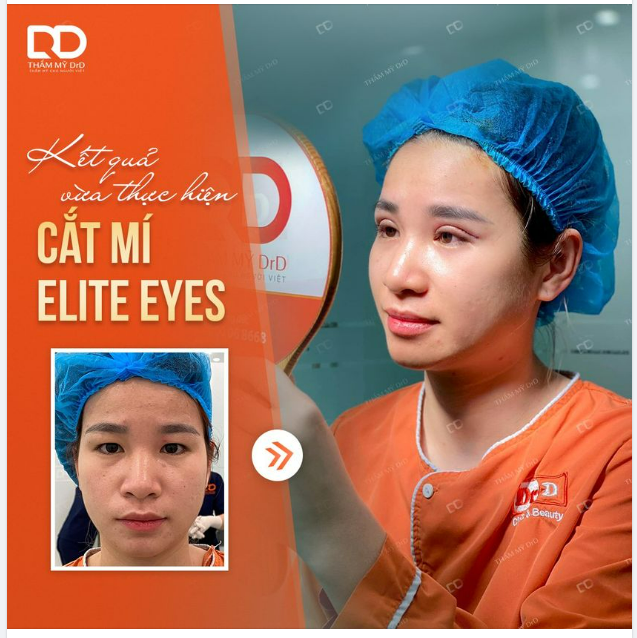 Da mí dày Làm mi mắt sụp xuống như mắt một mí ​​​​​​​ Mất tự tin